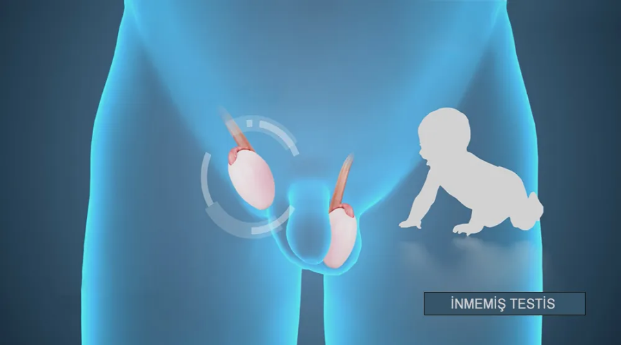 İnmemiş Testis